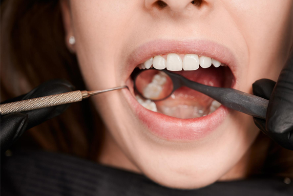 Cracked tooth treatment at EAZY-Dental