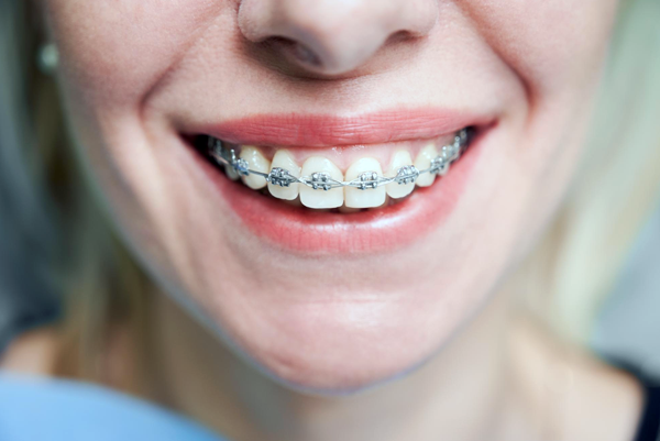 Smile doctors store braces